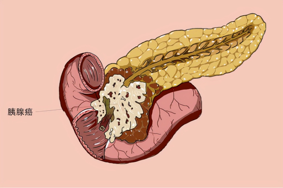 你以为的胃病，可能是胰腺问题，这些症状要分清