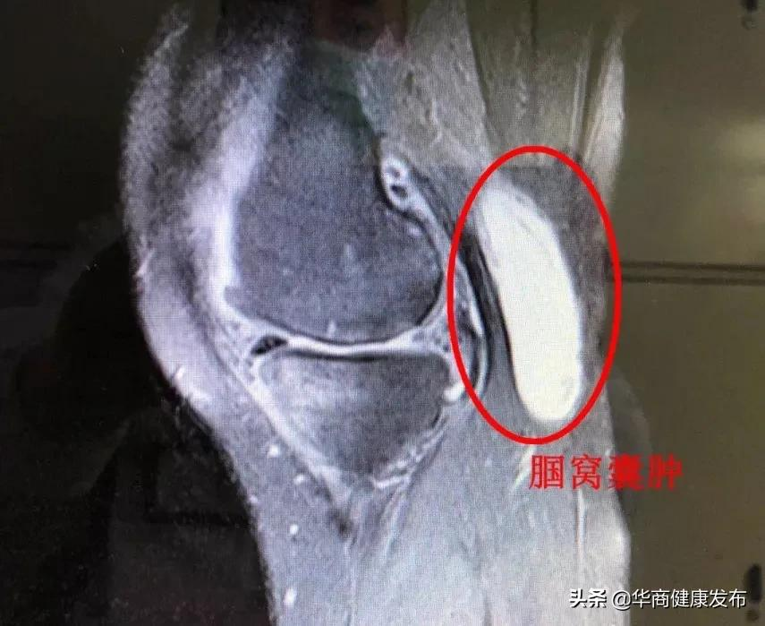 4个0.5cm微小切口的手术巧取膝关节腘窝囊肿