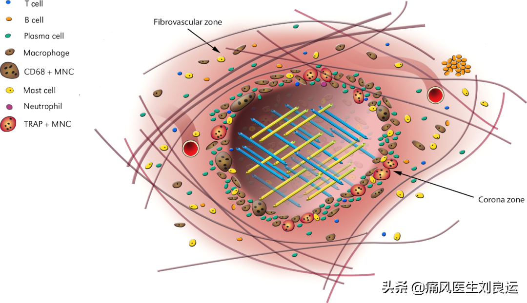 饮食清淡却患上痛风这种“富贵病”，26岁小伙用针挑破痛风石