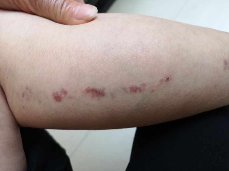 初级苔藓皮肤病图片(长成一条线的就是线状苔癣) - 赤虎壹号