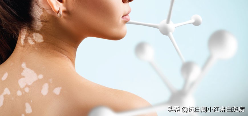 如何准确鉴别白癜风与其他类型白斑