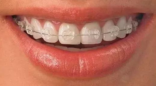 陶瓷牙齿多少钱一个图片