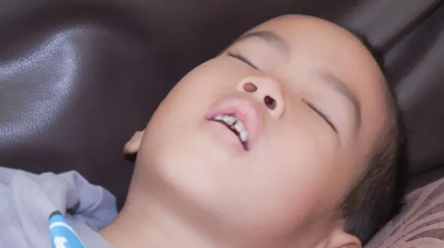 长期张嘴呼吸面容图片(口呼吸造成咬合不正) - 赤虎壹号