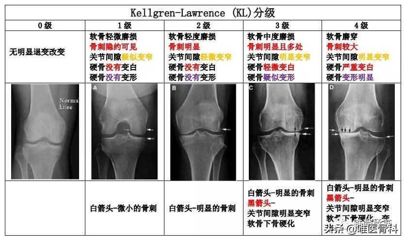 关节炎打玻璃酸钠作为“润滑针”，到底有没有用？