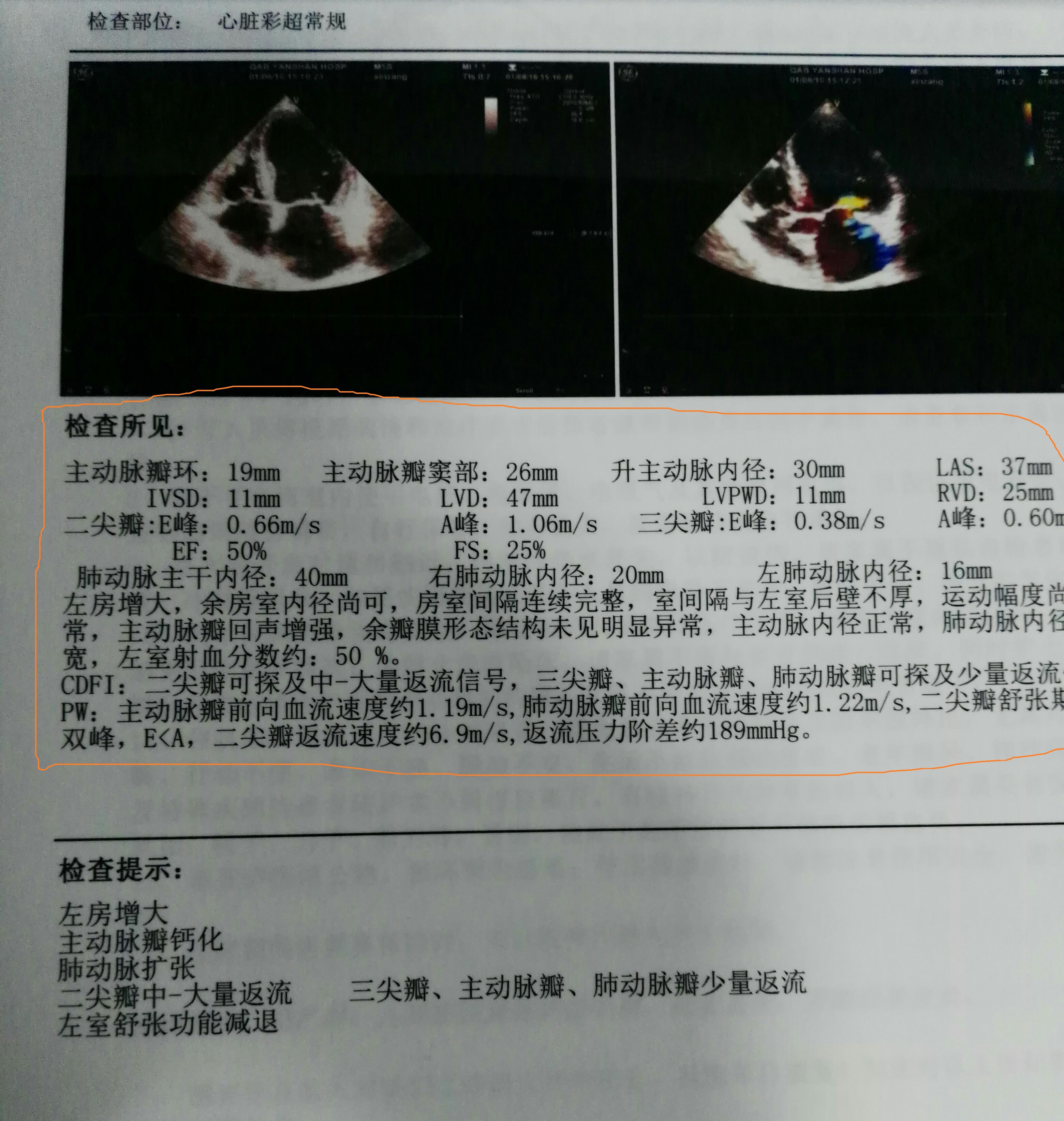 检查心脏，心电图、心脏彩超哪个更准确？看看医生怎么说