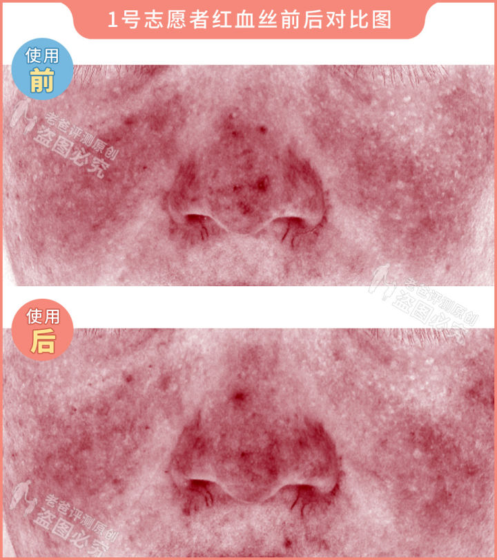 网红家用美容仪真的有效吗？2个多月的跟踪实测结果来了