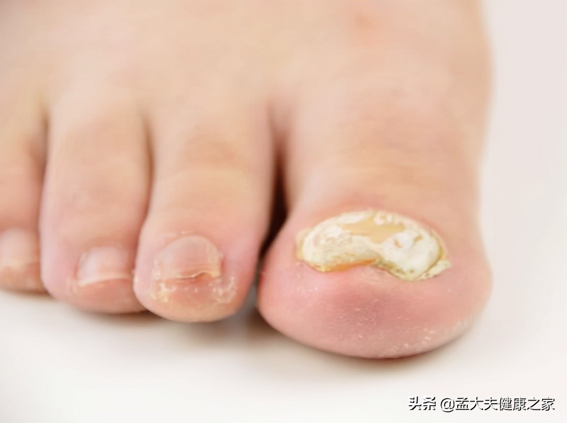 得了灰指甲怎么治？2个治疗方法效果好，安全不复发