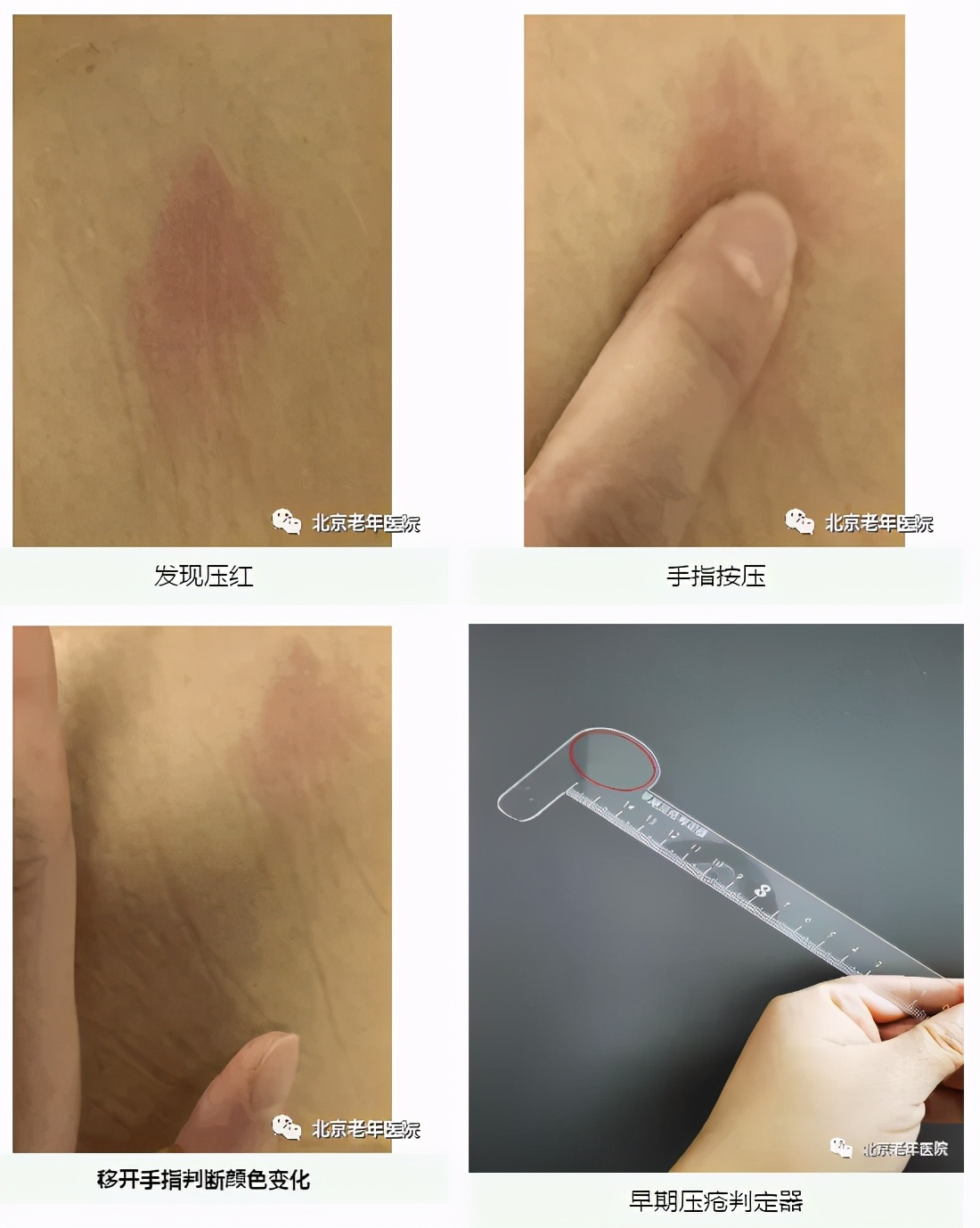 居家照护者如何识别早期压疮？