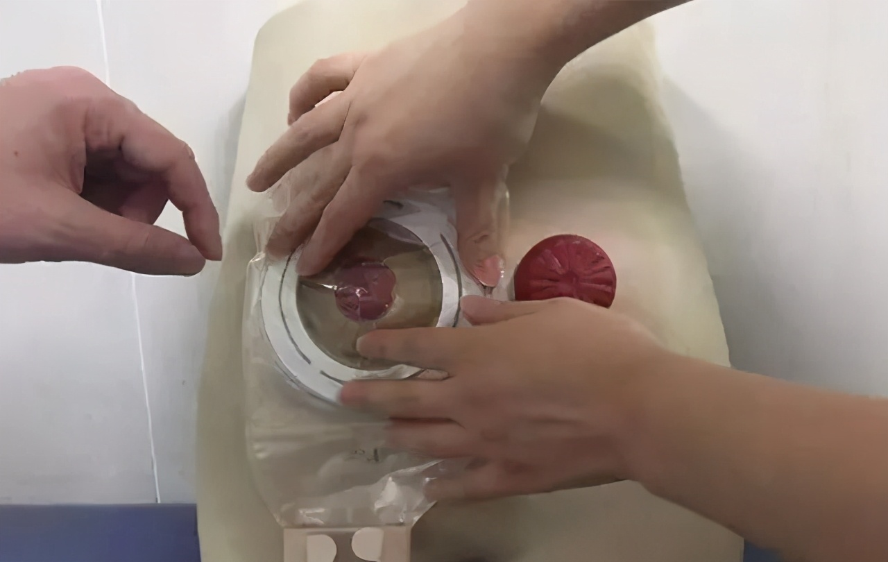 每年10万人失去肛门