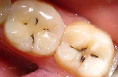 牙齿上的黑线为什么抠不掉？牙医告诉你真相，还你一口干净的好牙