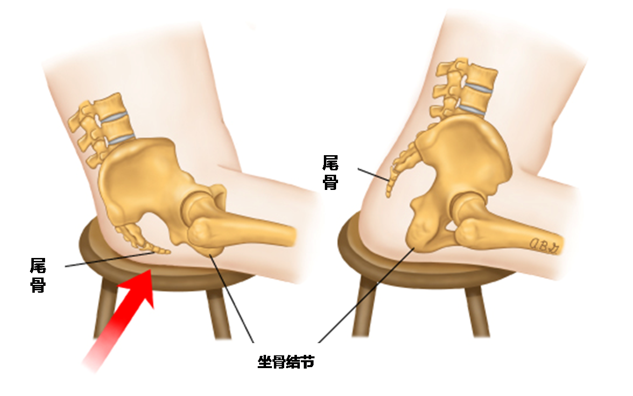 路医生说丨尾骨受伤后总疼痛，除了“静养”有没有其他治疗方法？