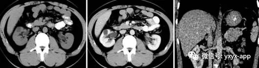 肾囊肿CT病例图片影像诊断分析
