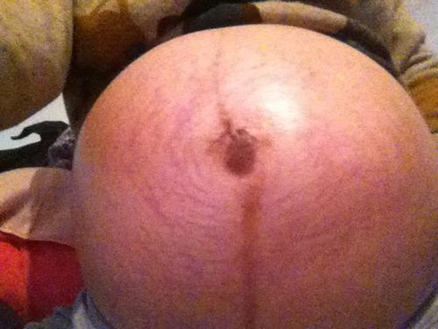 怀孕后肚皮上长“黑线”？准妈妈别苦恼，做好4件事有利于恢复