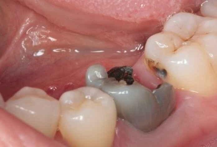 一般龋齿在发展初期,不会有十分明显的症状,仅仅是在牙齿表面出现一些