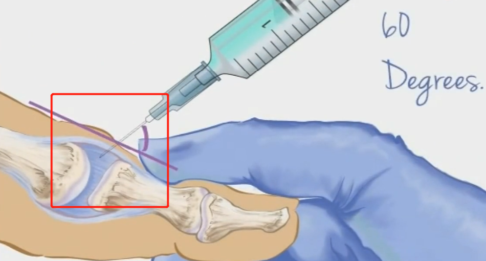 手指有腱鞘炎，怎么治才能好得快？别花冤枉钱了，医生教您5招