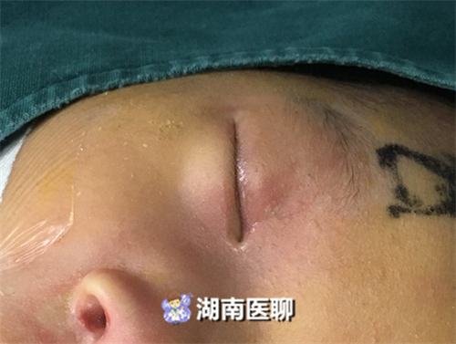 鼻泪管手术多少钱(痛心) - 价格百科