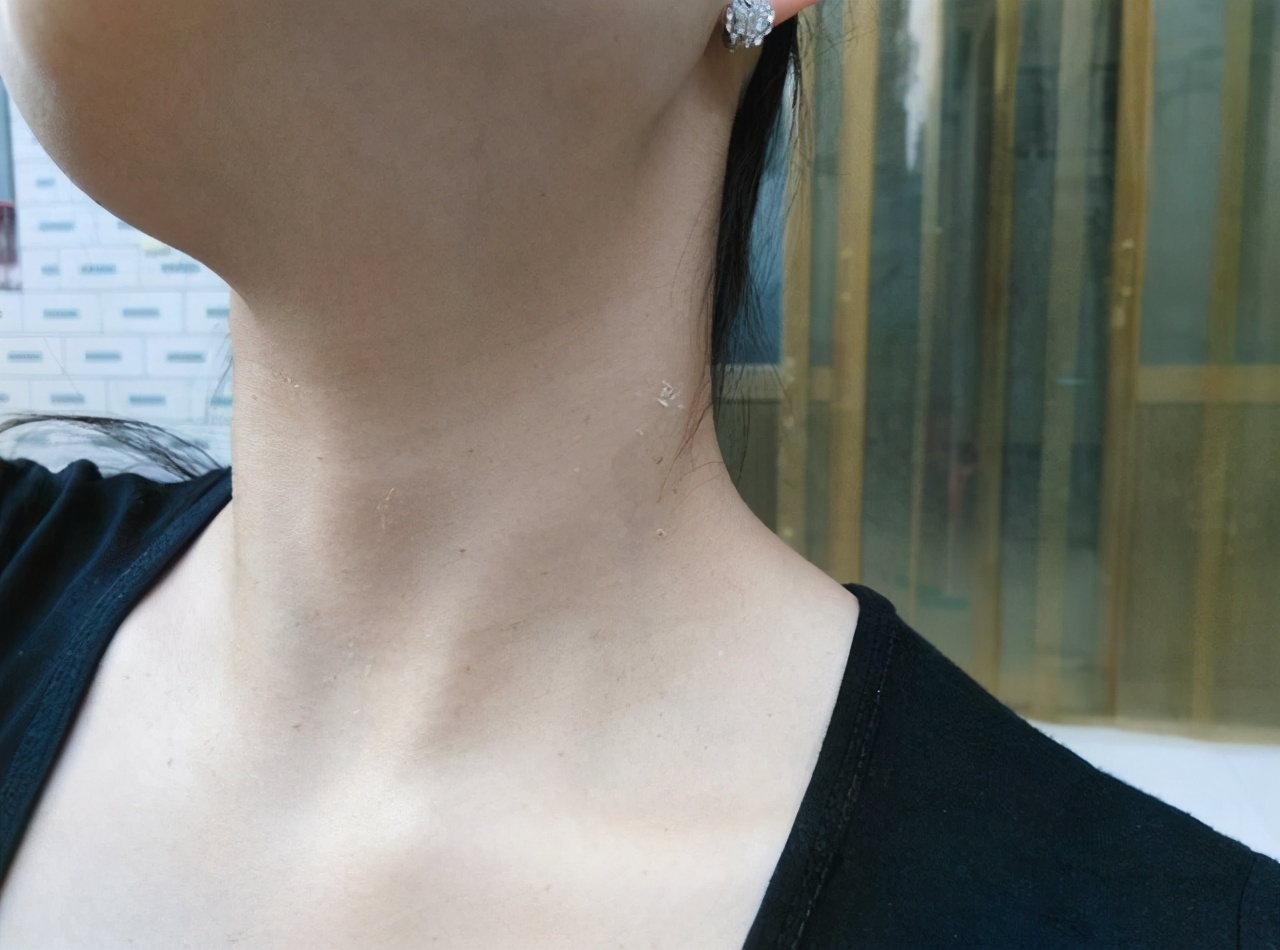 脖子和腋下的"小肉粒"是啥?影响身体健康吗?医生建议引起重视