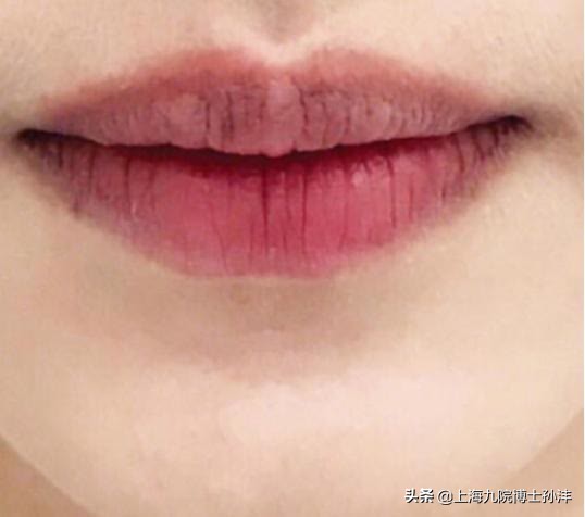 嘴唇外翻怎么矫正(九院孙沣士:嘴唇形态不好看,该怎么整才好?