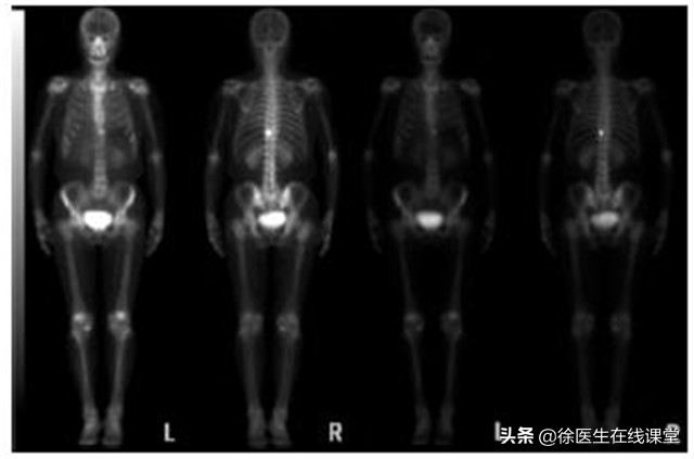 肿瘤标志物、PET CT/MR等眼花缭乱的全身防癌筛查，值得做吗？