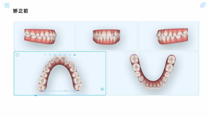广州牙齿矫正杨露隐适美隐形矫正戴牙套全案例