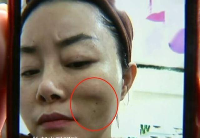 42岁的琳琳便是一个十分惧怕衰老的女人,于是花费3万元做了个拉皮手术