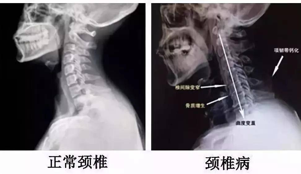 6岁孩子患颈椎病！颈椎病有哪些症状？3个自测实验可以试试