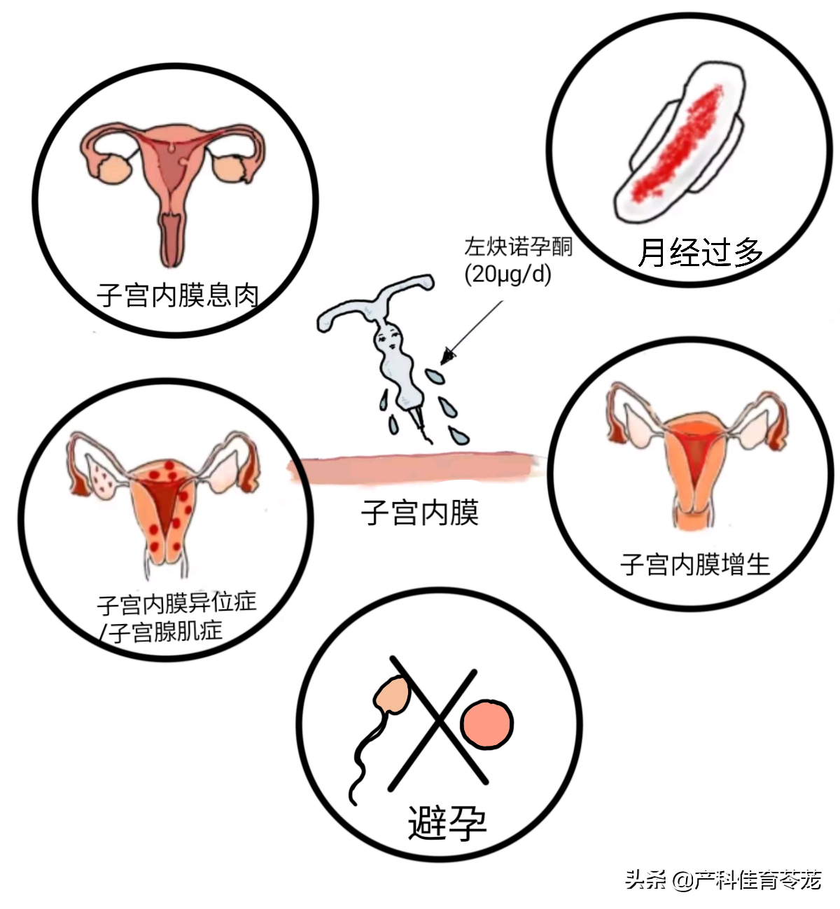 1,帶銅節育器(母體樂,t型環等)優點:可以常規避孕,也可以用於緊急避孕