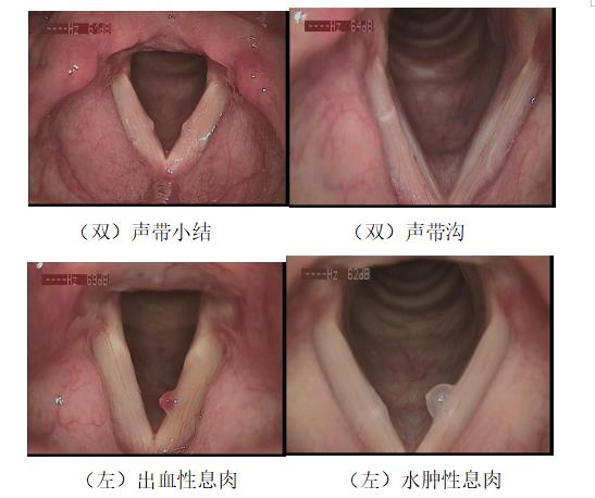 耳鼻喉医话丨我声音嘶哑了，喉镜检查必须做吗？