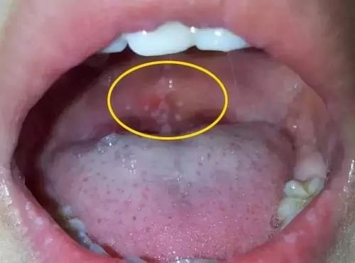 两个症状的区别帮助区分正常的舌苔发白和鹅口疮