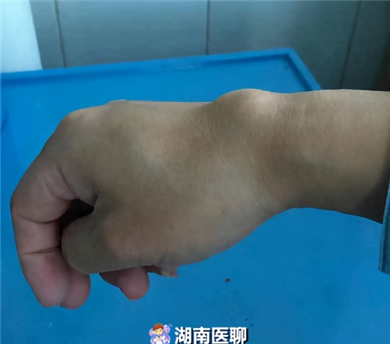 手腕疼还鼓个包!腱鞘囊肿青睐办公一族,如何减少它的发生?