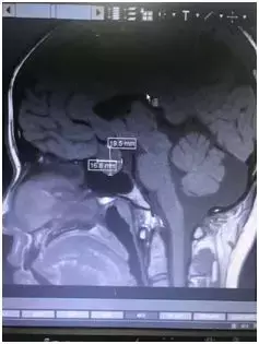 既未婚，又没有男盆友！20岁女大学生分泌乳汁？！