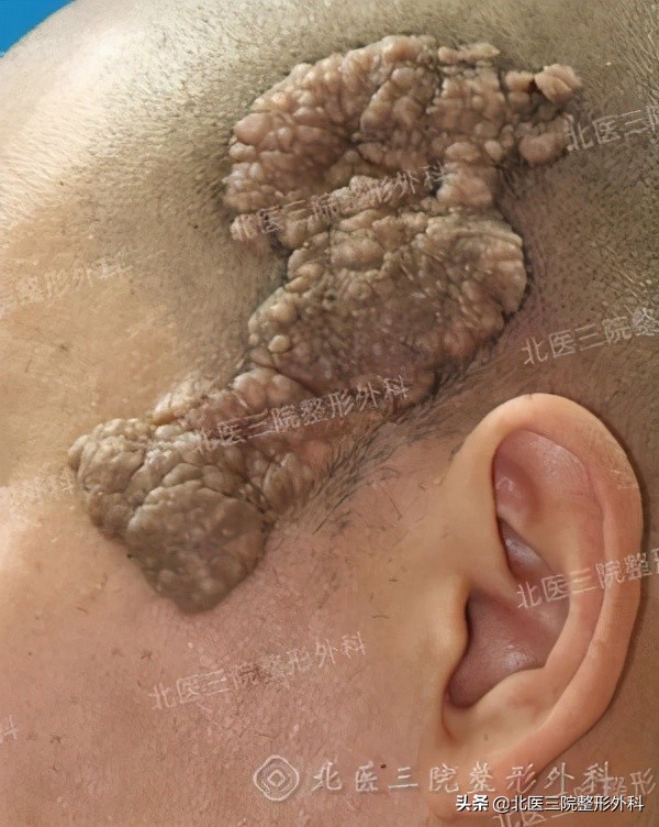 聊一聊：你熟悉的“痦子”