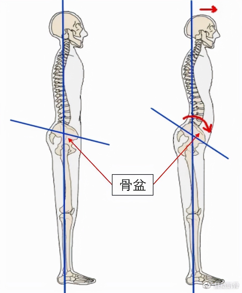 你以为的“翘臀”，可能是骨盆前倾了