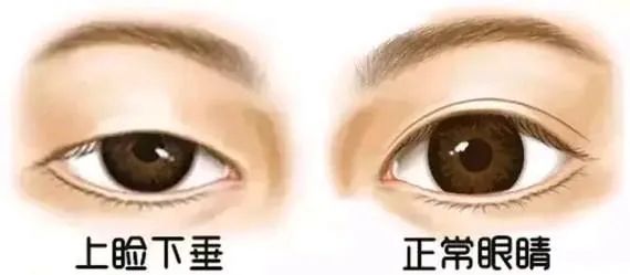 眼皮下垂的原因有哪些？如何保养？看这里
