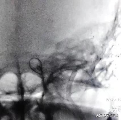 血管内取栓治疗超时间窗的左侧大脑中动脉闭塞