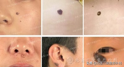 聊一聊：你熟悉的“痦子”