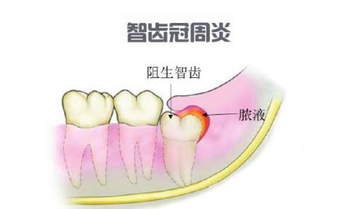 智齿冠周炎图片 冠周炎图片