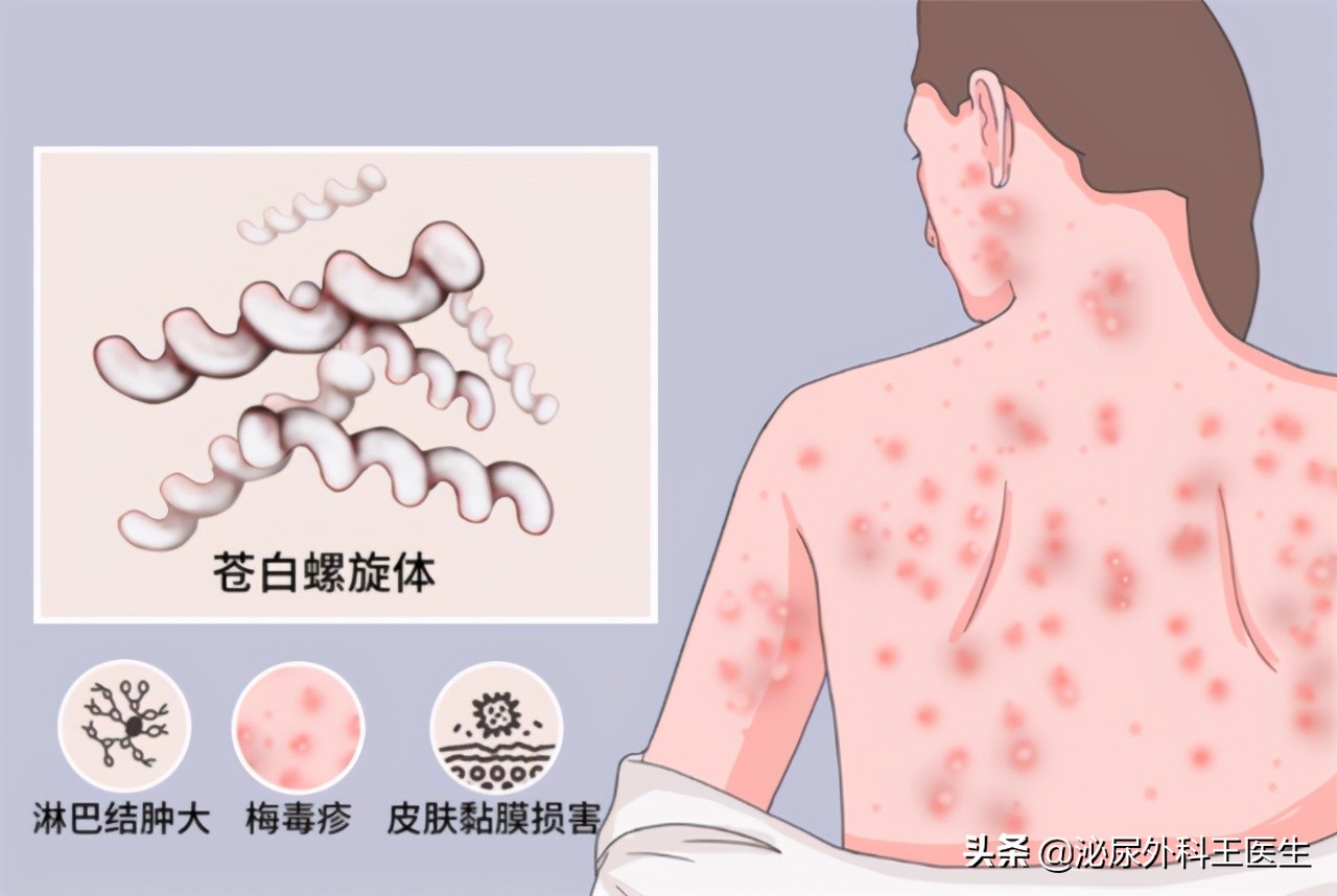 60岁老人没有夫妻生活，却被查出梅毒！3个传播途径，不少人中招