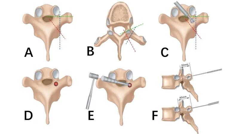 蛇眼一针法：颈胸椎椎弓根螺钉置入新方法