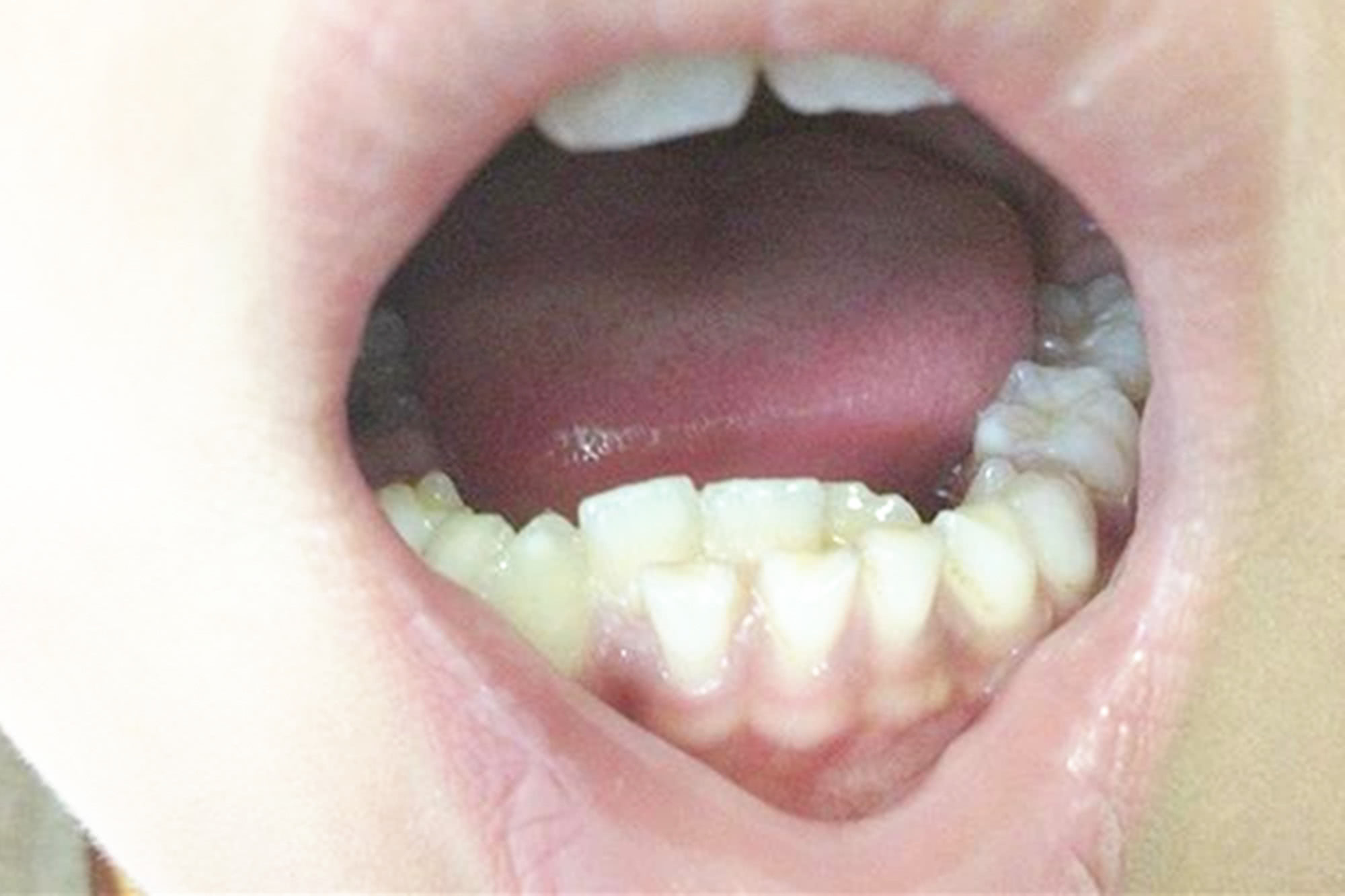 74被嘲笑孩子的双排牙齿基本是不好看的,还会导致恒牙的不整齐,大人