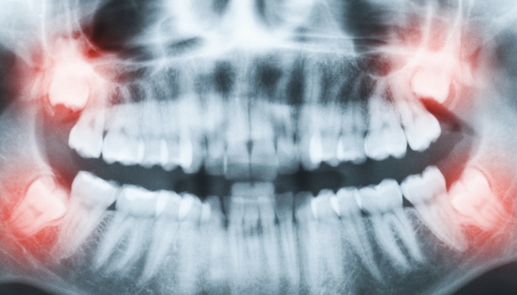 智齿拔牙价格分析，智齿拔牙医保报销比例详解？