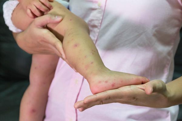 水痘的症状和治疗图片，初期和潜伏期的症状？