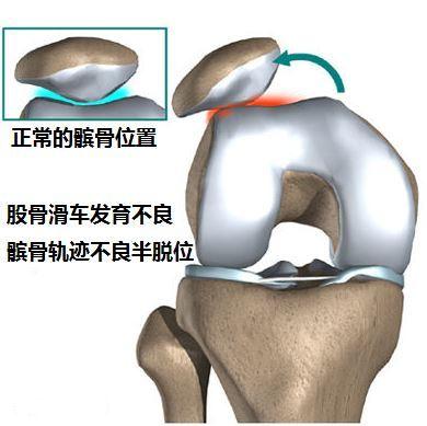 nba哪些球員髕骨軟化（從丁彥雨航的康復(fù)過程，學(xué)習(xí)髕骨軟骨軟化的康復(fù)思路）