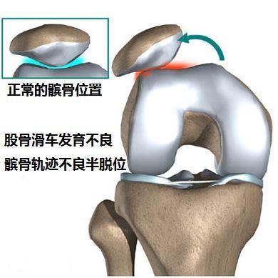 nba哪些球员髌骨软化（从丁彦雨航的康复过程，学习髌骨软骨软化的康复思路）