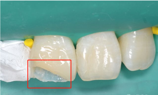 牙釉质脱落要重视,别因为侥幸毁了一口牙