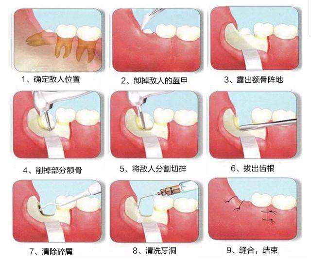 拔上智齿过程图解图片