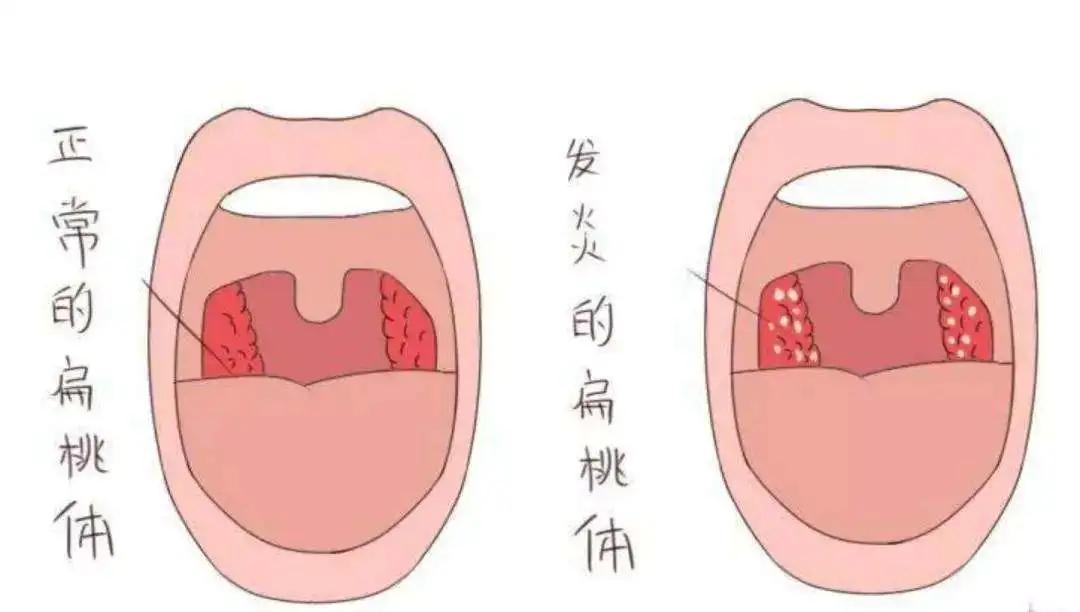 除了发炎你还会干啥？“背锅侠”扁桃体：说出来怕吓着你