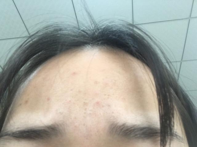 闭口粉刺如何祛除？