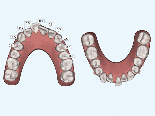 只有几颗牙齿长歪了，可以只做半口矫正吗？事情没你想的那么简单