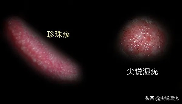 珍珠疹图片(珍珠疹的外观) -新时代资讯